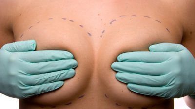 Desarrollan un gel de plaquetas que reconstruye la mama tras extirpar tumor