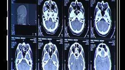 Desciende la mortalidad del cáncer algo más del uno por ciento en los ultimos años