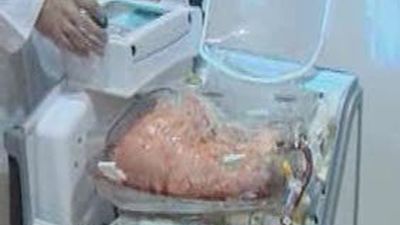 El Puerta de Hierro presenta un sistema para que  los pulmones para transplantes "sigan respirando"