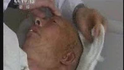 Un hombre chino ha tenido 23 años una bala en el cerebro