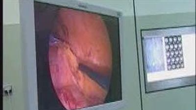 Primer trasplante en cadena en España