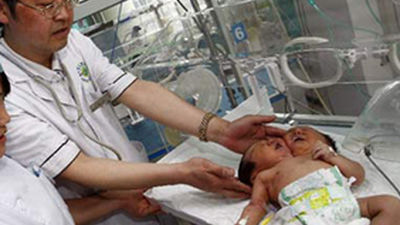 Nacen en el suroeste de China dos siamesas con un solo cuerpo