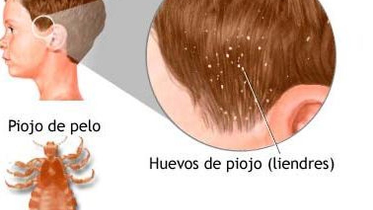 Dolores de espalda y pies, mala visión y la aparición  de piojos, problemas típicos de la vuelta al cole