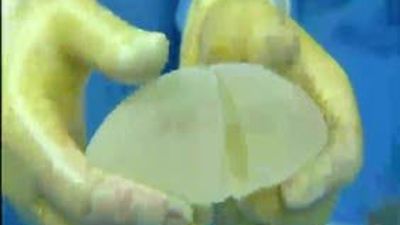 Hablamos sobre las prótesis mamarias PIP: ¿las mujeres están protegidas?