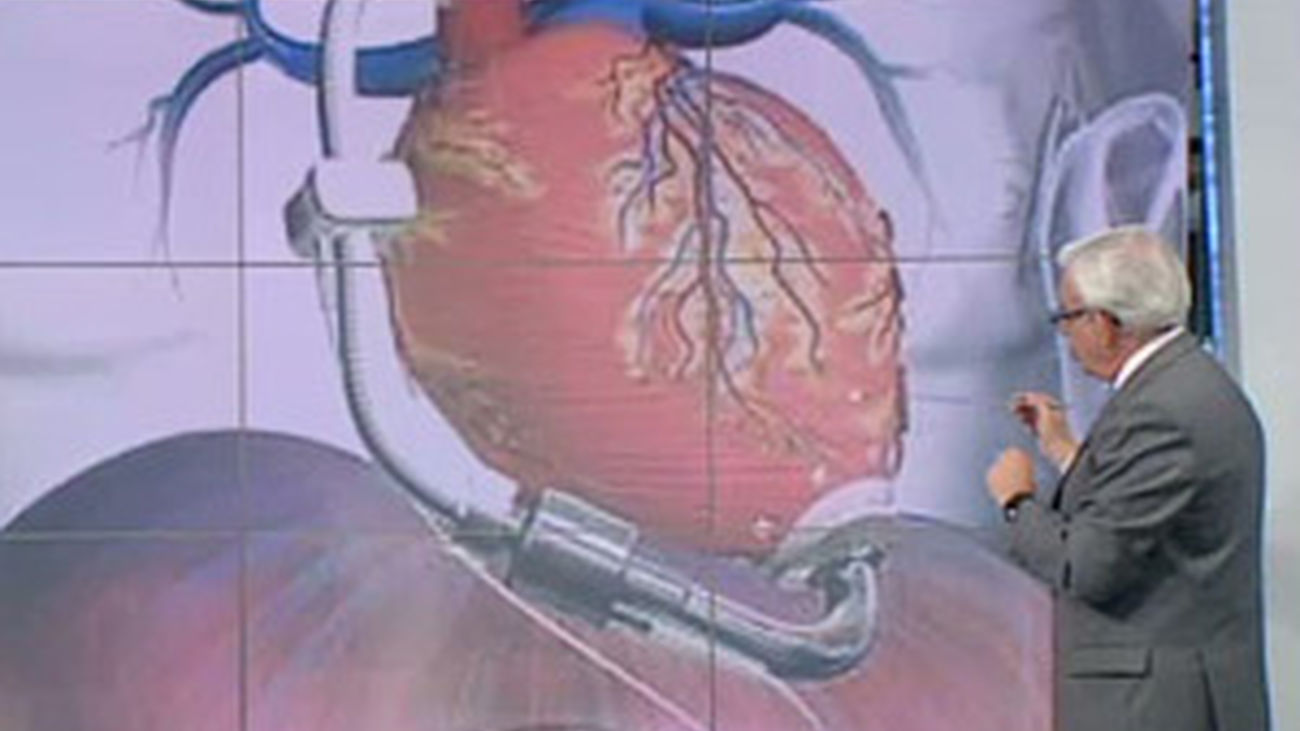 ¿El corazón artificial es una alternativa al trasplante?