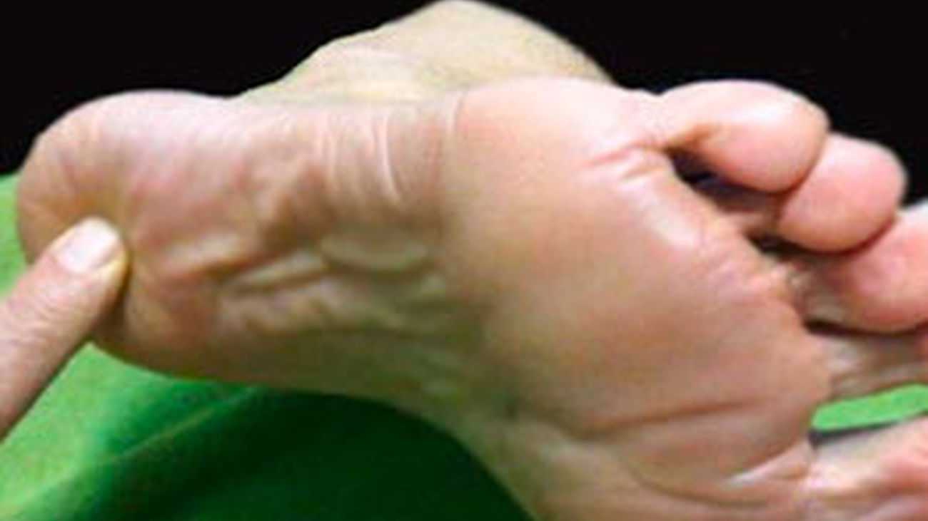 El espolón calcáneo