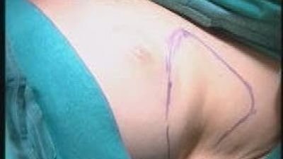 Grasa del abdomen para reconstruir mamas