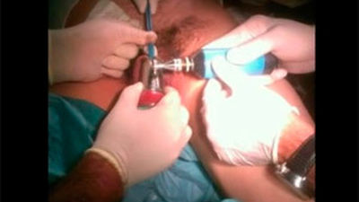 Se le quedó el pene en un tubo de acero... y hubo que llamar a los bomberos