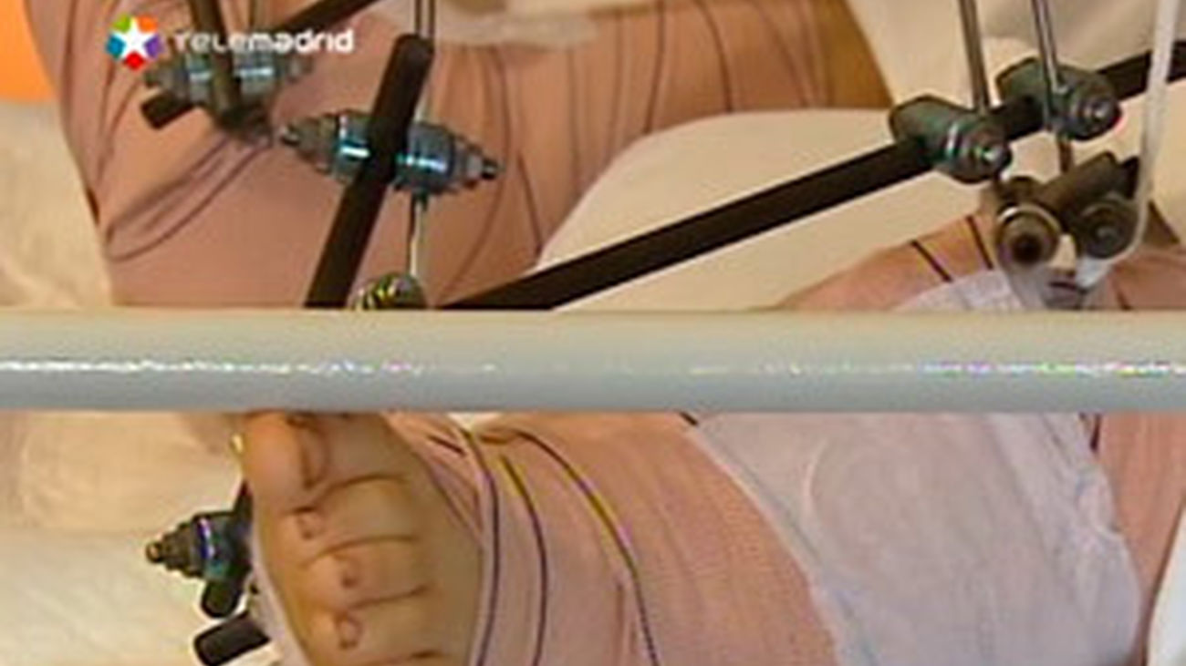 Reimplante total de pies