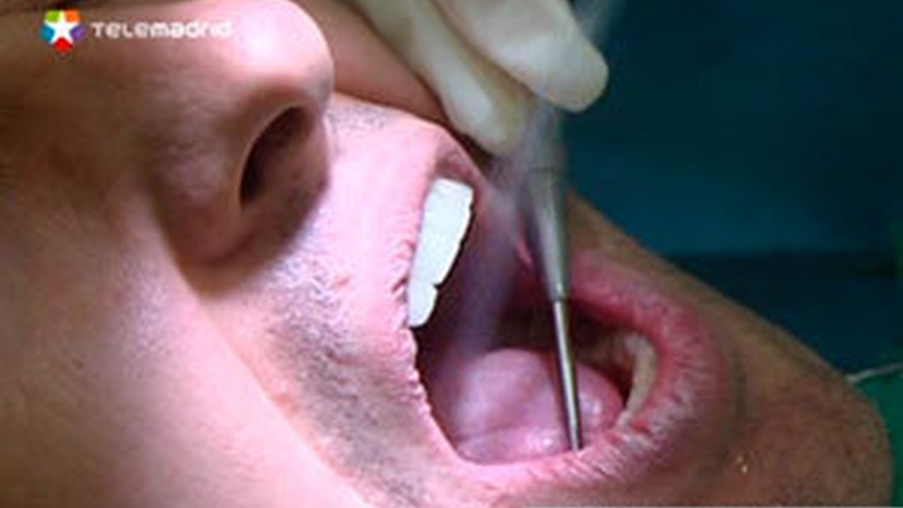 Cómo funcionan los implantes dentales