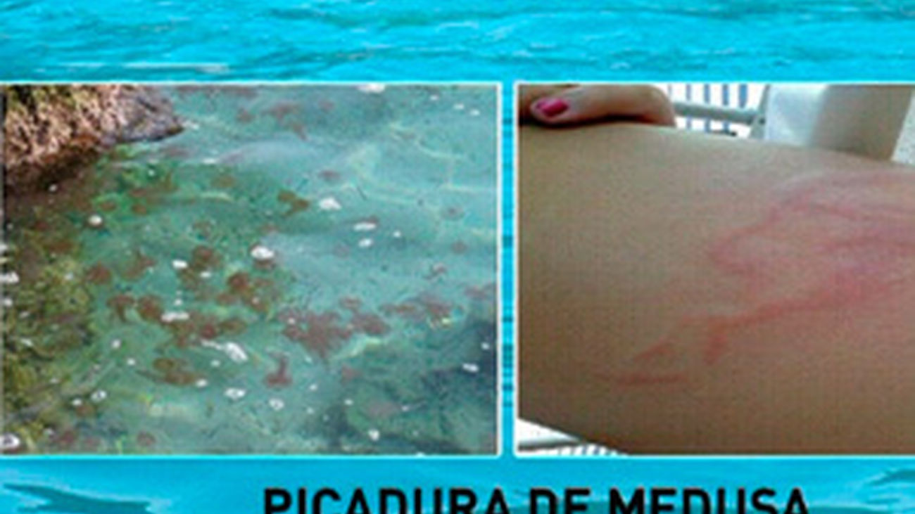 ¿Cómo curamos las picaduras?