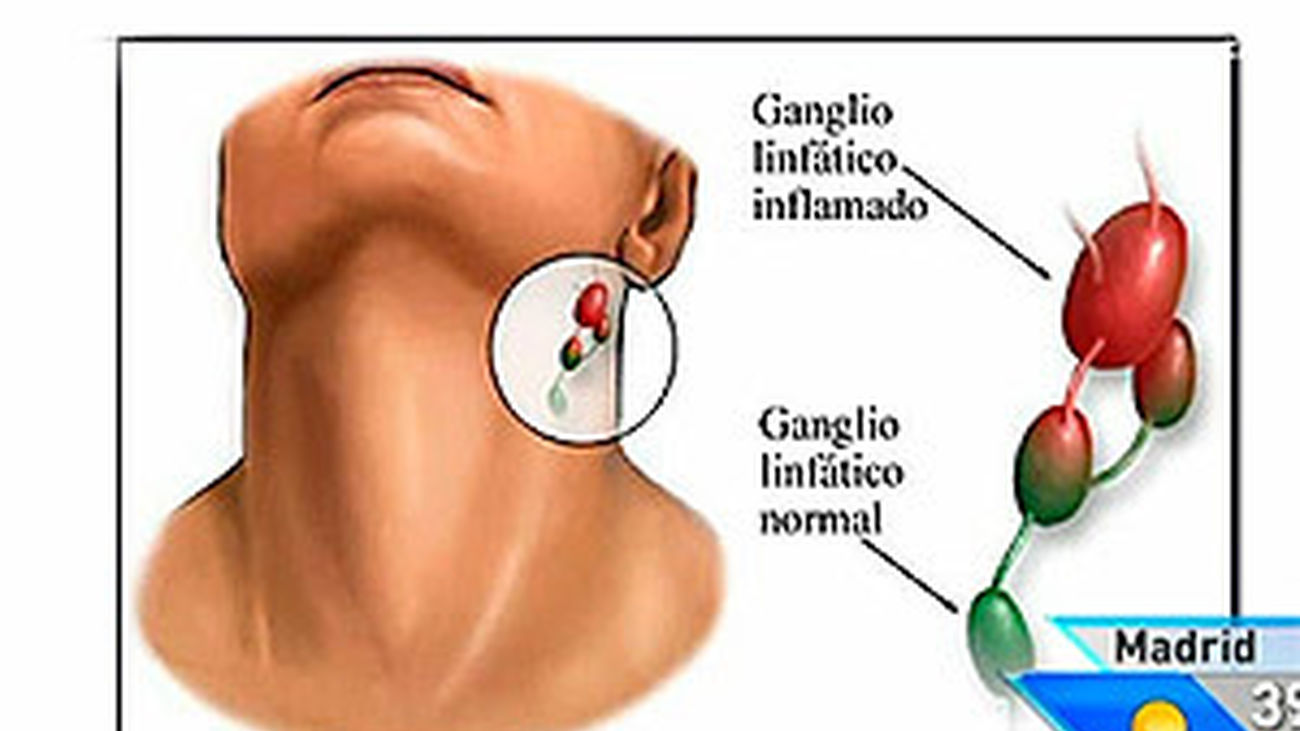 ¿Qué es la enfermedad del beso?