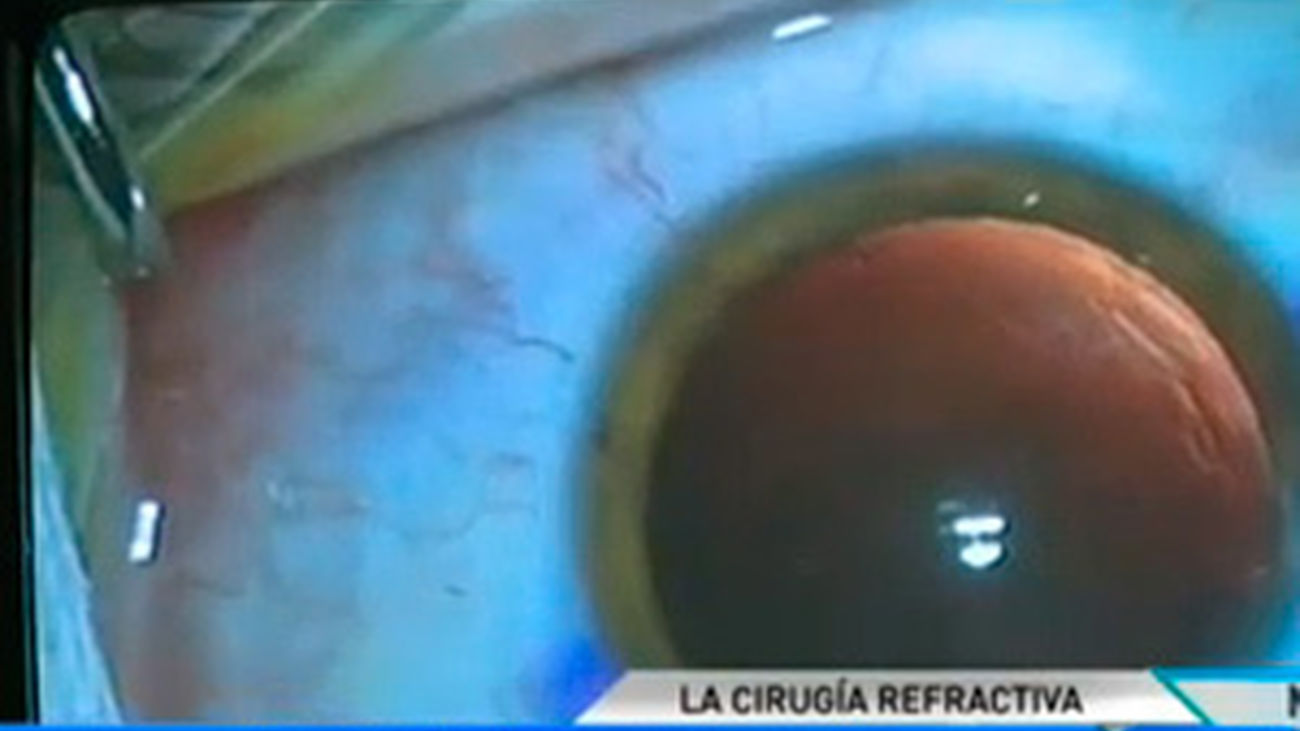 Solución ante la miopía y la hipermetropia