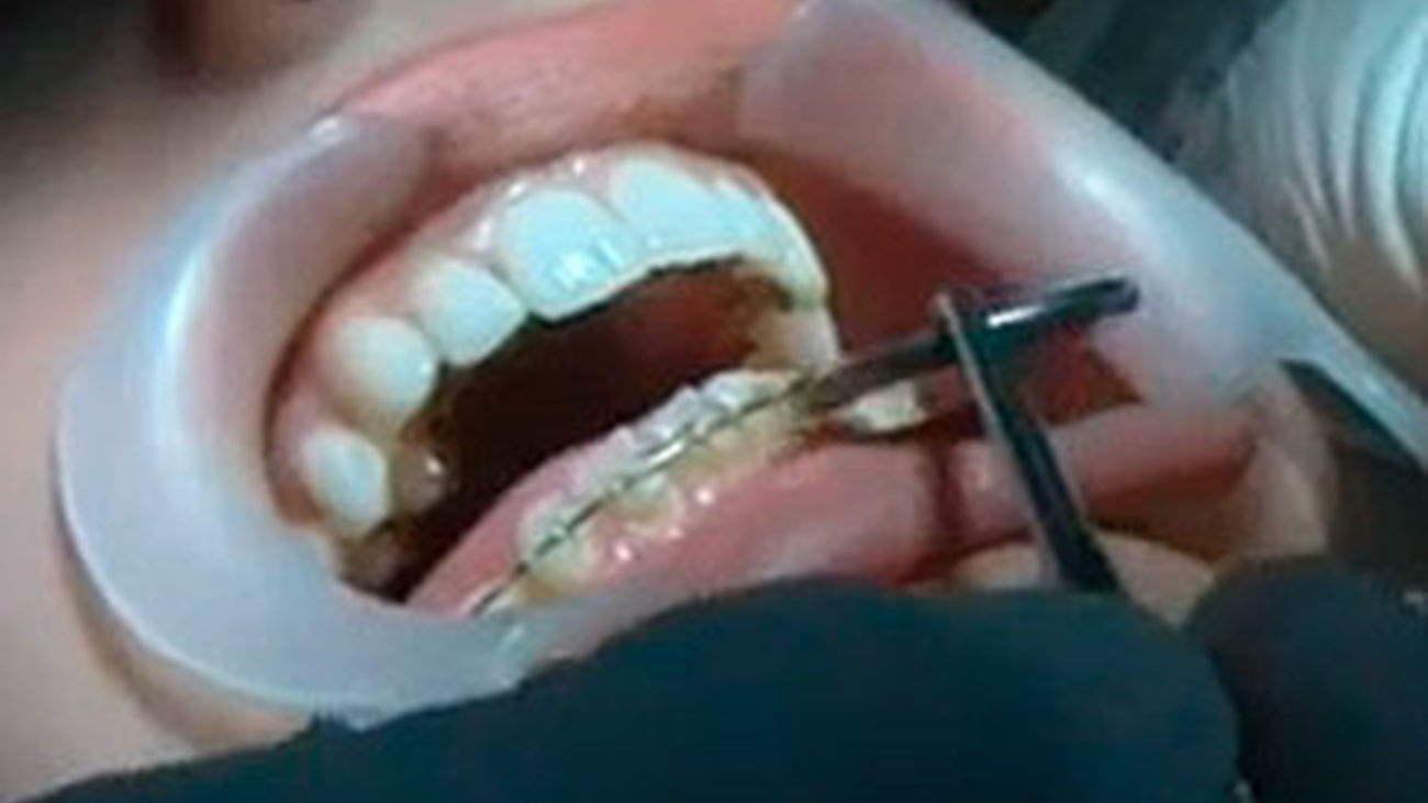 Cómo se realiza una ortodoncia