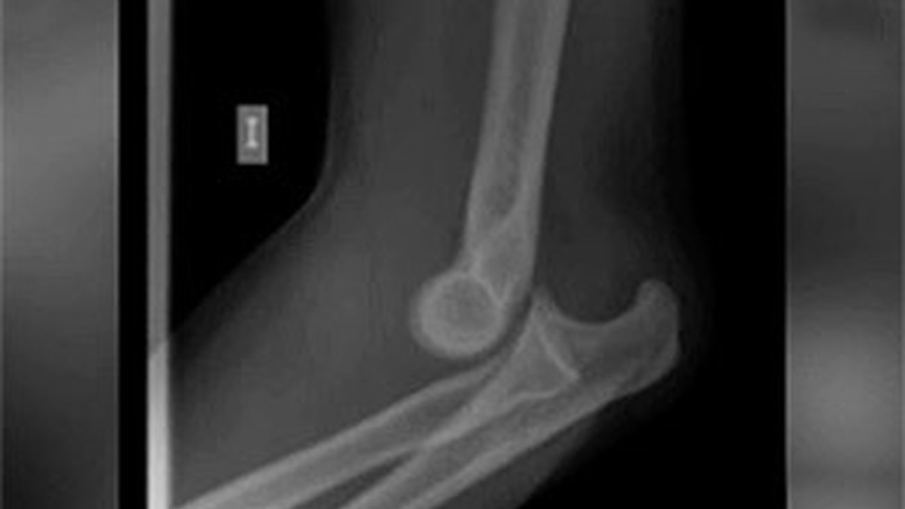 Luxaciones: cómo se producen y cuál es su tratamiento