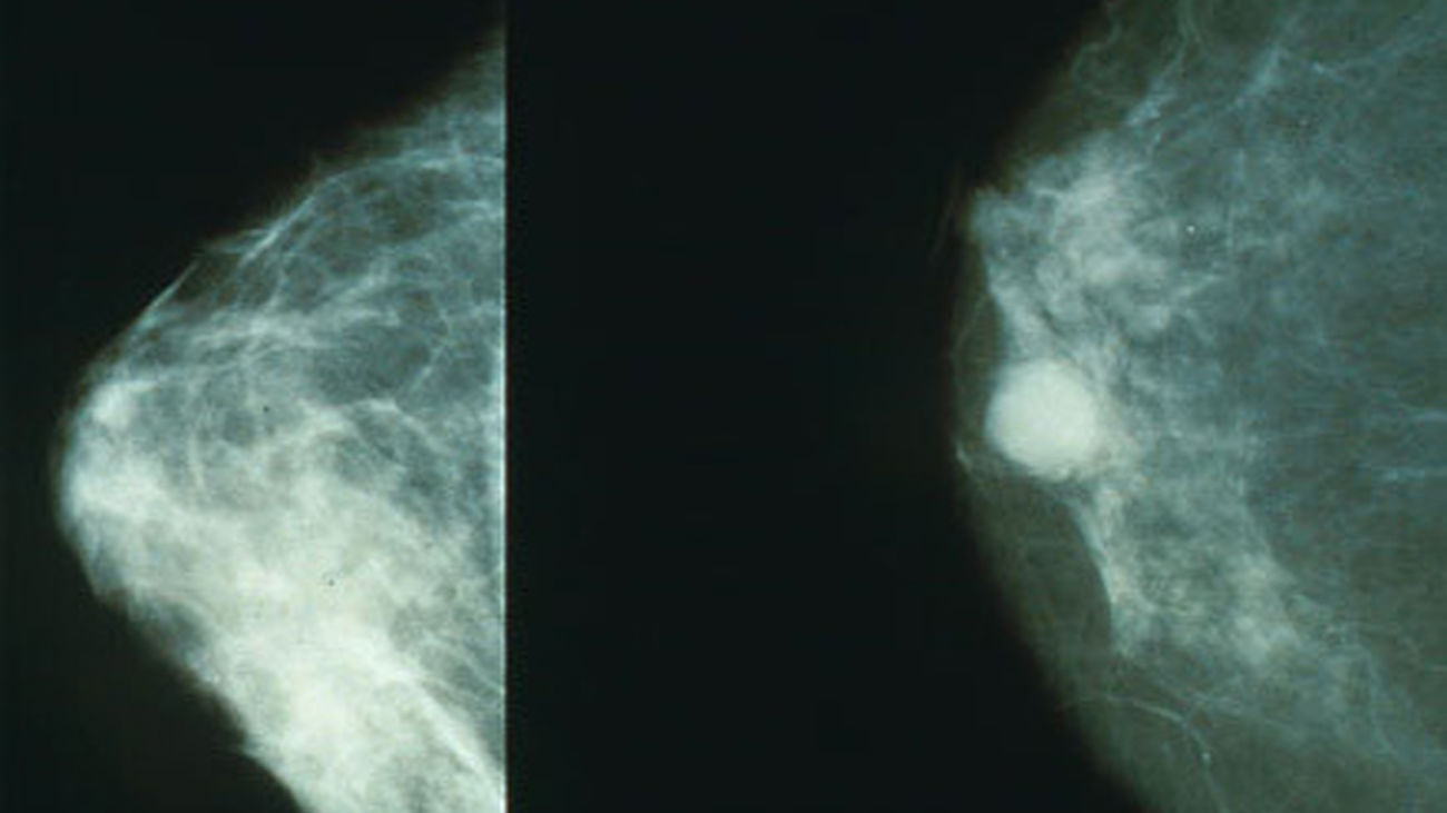 cancer_mamografia