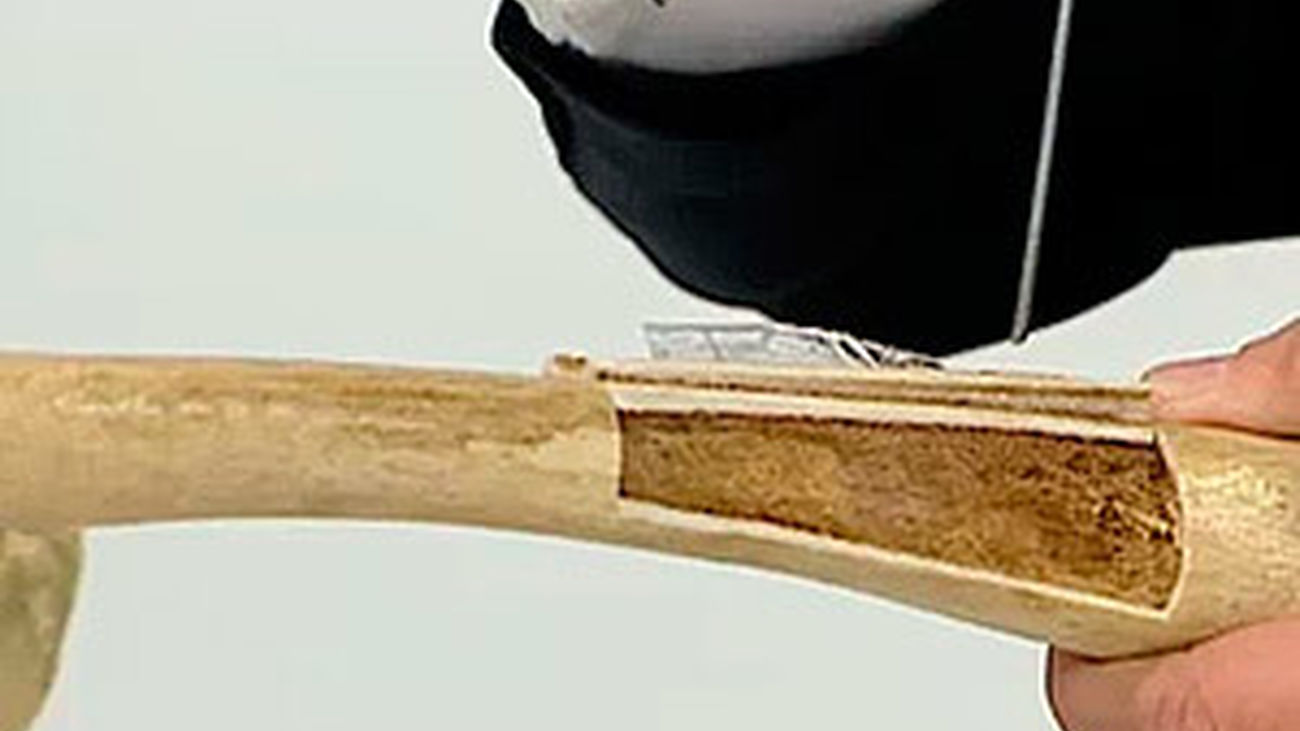 La osteoporosis, una epidemia silenciosa