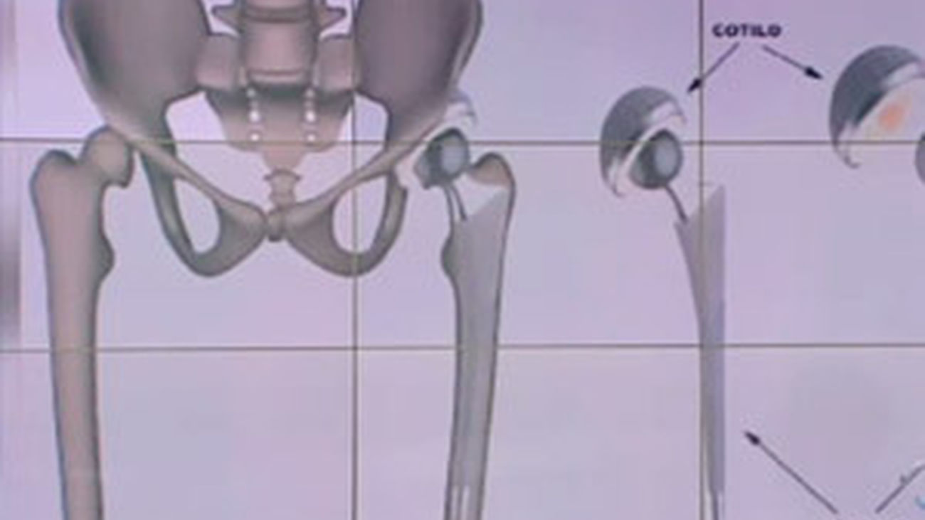 La prótesis de cadera