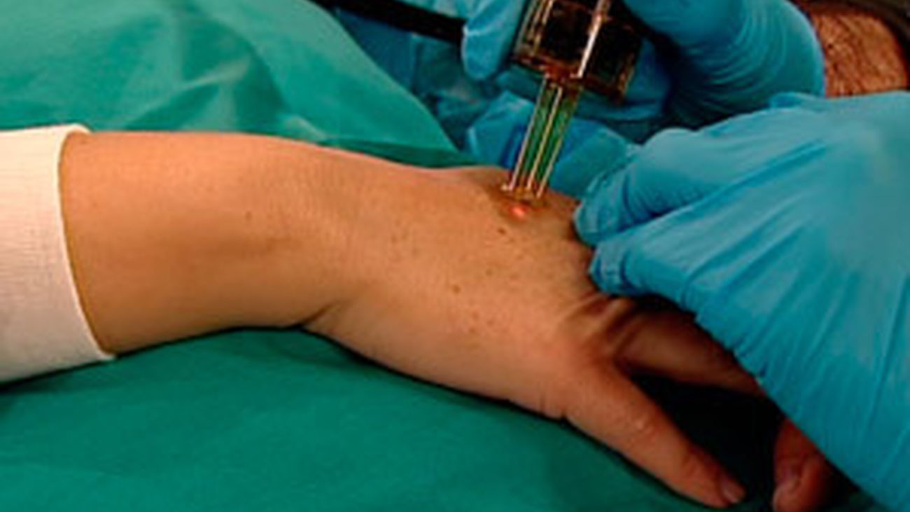 Quitar las manchas de la piel con láser