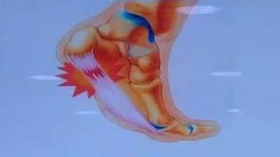 Lesiones en Acción: Fascitis plantar