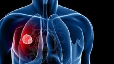 Un 60% de los pacientes con cáncer deben ser tratados con radioterapia