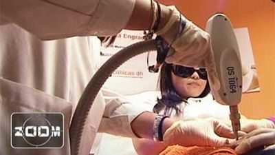 Láser contra los tatuajes