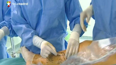 El Hospital de Torrejón introduce el tratamiento láser de las varices