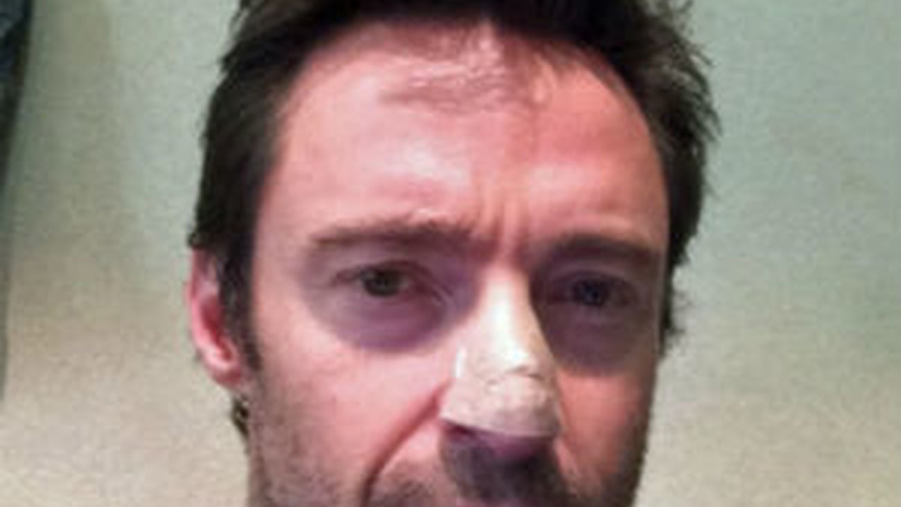 Hugh Jackman revela que padece cáncer de piel