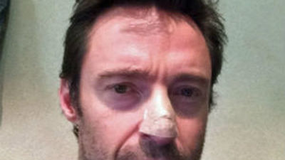 Hugh Jackman revela que padece cáncer de piel