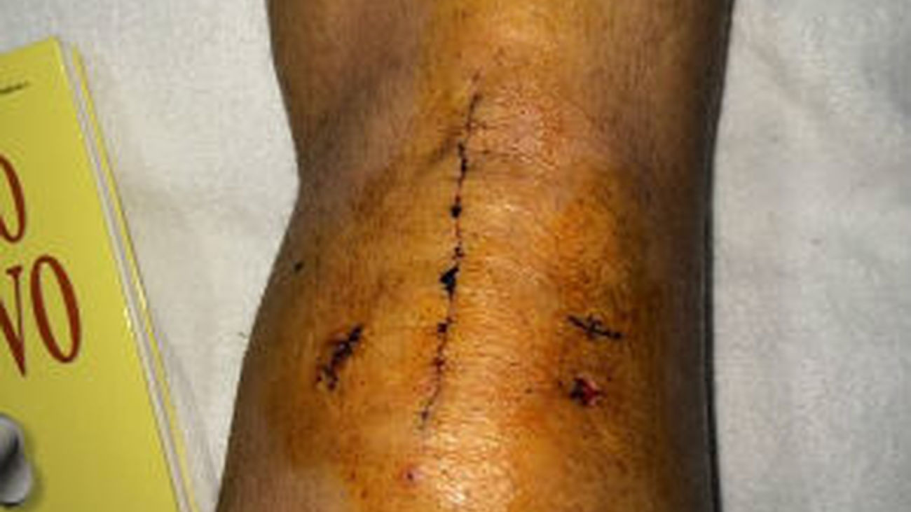 Jesé muestra la rodilla operada: "Vamos avanzando"