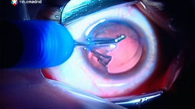 Torrejón de Ardoz aplica una novedosa técnica para la intervención de cataratas