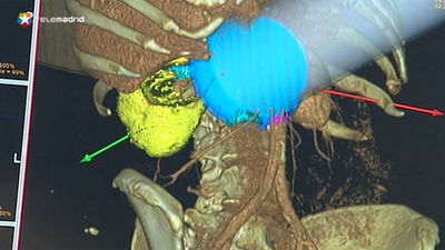 Nace el primer 'acelerador lineal de electrones' para tratar el cáncer