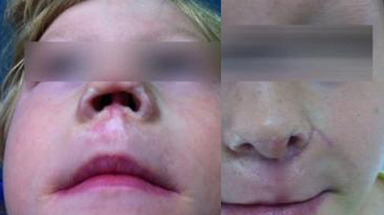 reconstruccion_nariz_213