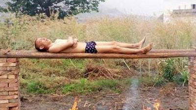 Un joven chino intenta curar su cáncer mediante una 'parrilla humana'