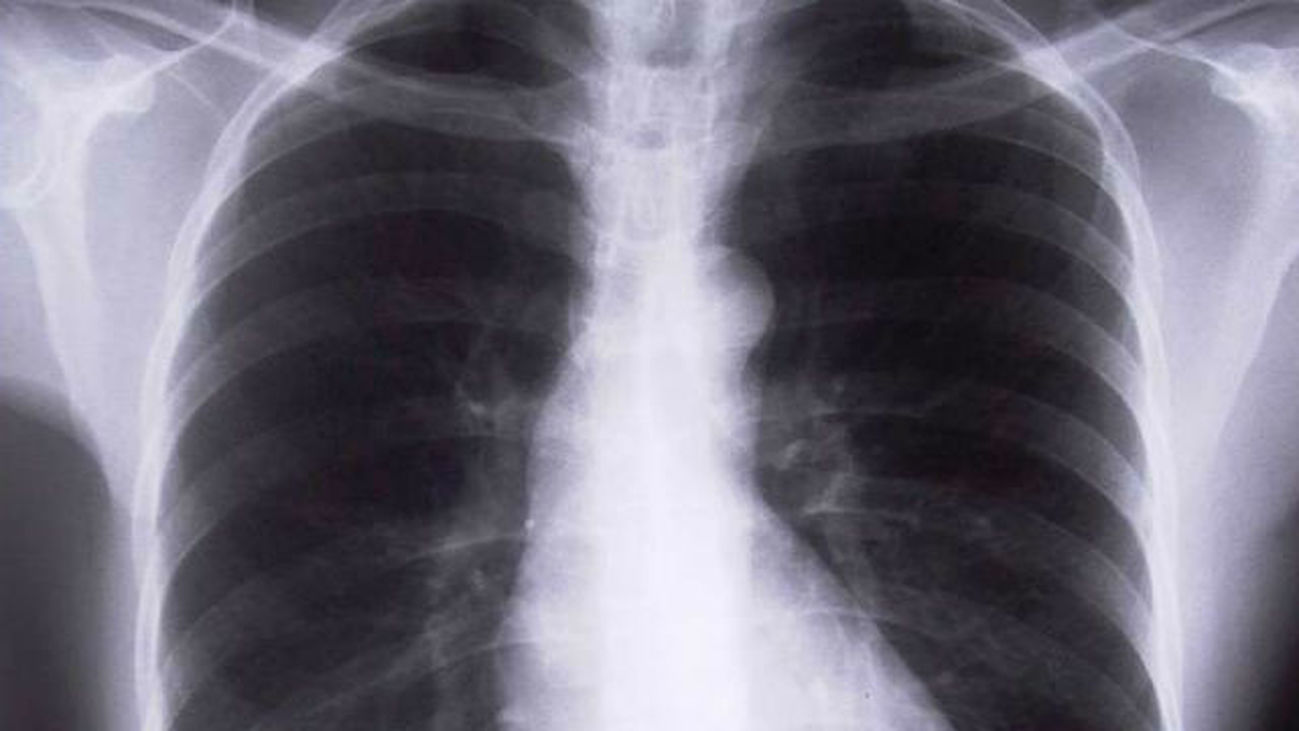 Investigadores españoles hallan el ‘talón de Aquiles’ cáncer de pulmón en la inhibición de una proteína