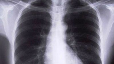 Investigadores españoles hallan el ‘talón de Aquiles’ cáncer de pulmón en la inhibición de una proteína