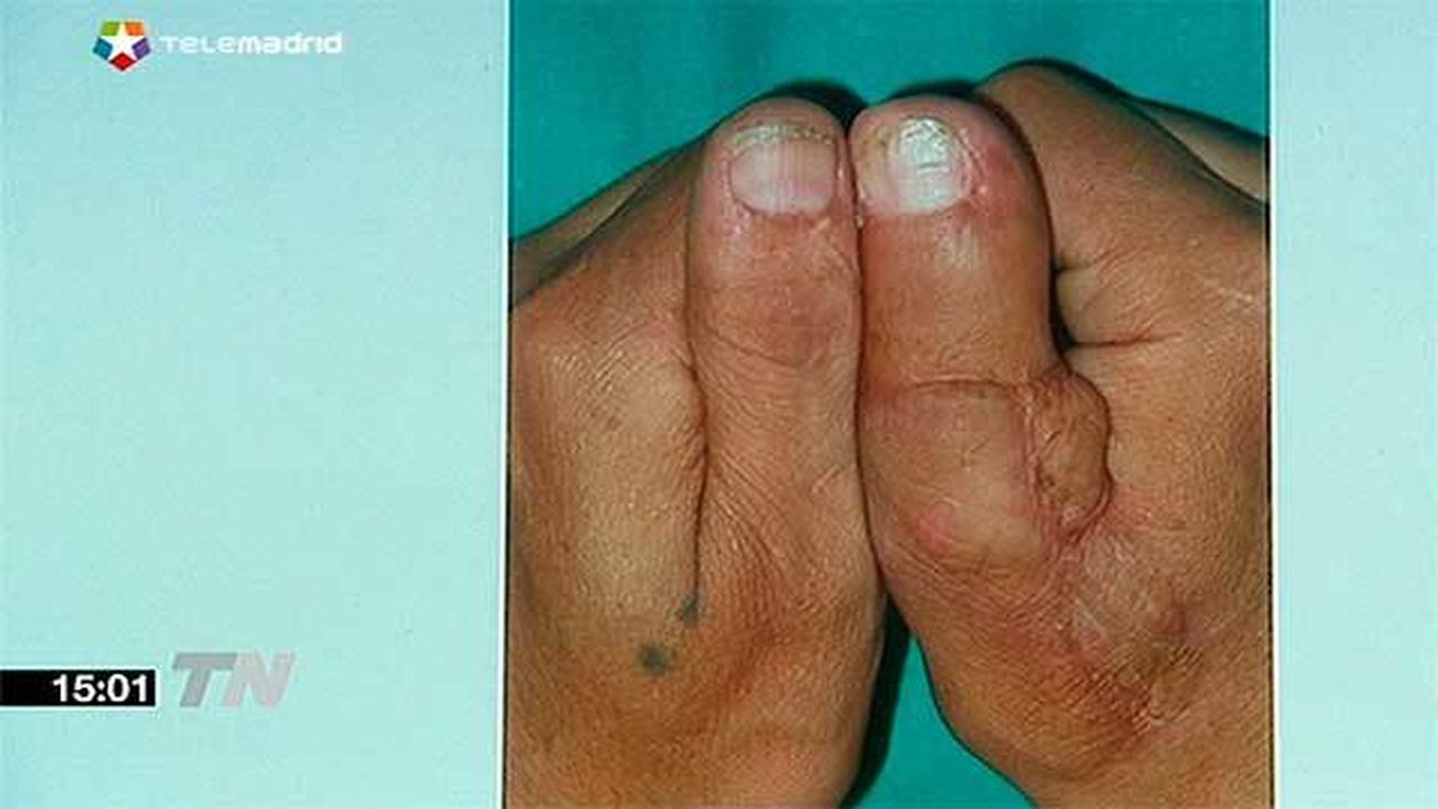 Reimplantes en La Paz