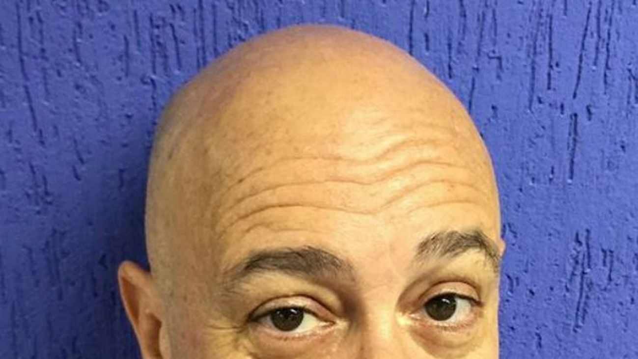 Crecepelos y disfunción eréctil