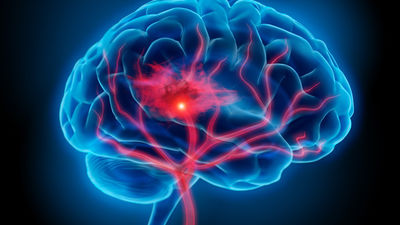 Cada año 11.000 madrileños sufren un ictus