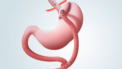 El hombre más obeso de España se ha sometido a un bypass gástrico