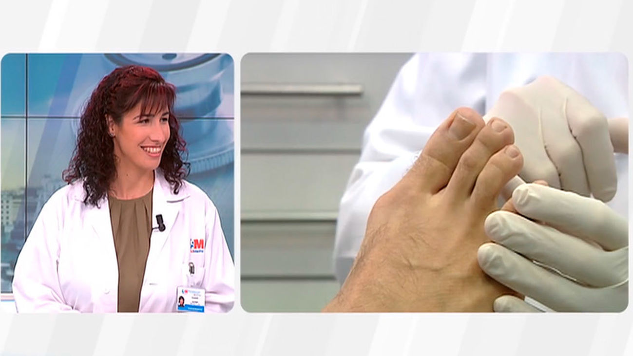 ¿Cómo evitar y tratar los hongos de los pies en verano?