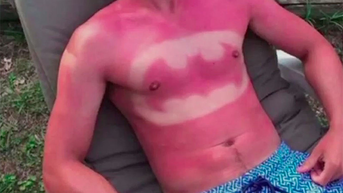 Tatuajes solares: una moda nada recomendable