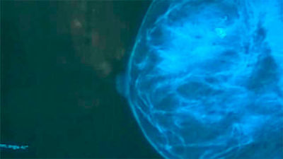 Los oncólogos rechazan hacer una primera mamografía a los 35 años como quieren los ginecólogos