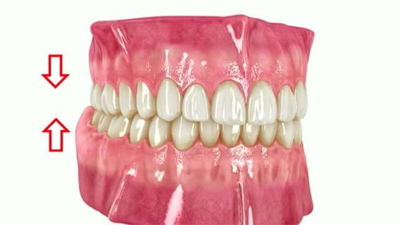 Bruxismo: qué es y cómo tratarlo