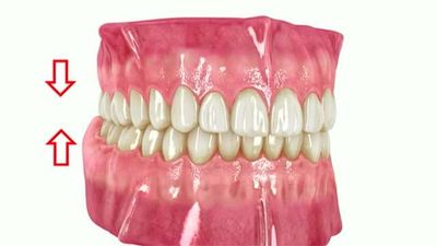 Bruxismo: qué es y cómo tratarlo