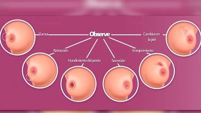 Cómo realizar la autoexploración de mamas