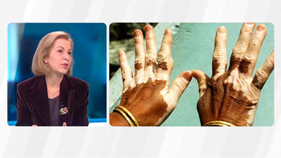 Vitíligo: Técnicas para pigmentar la piel