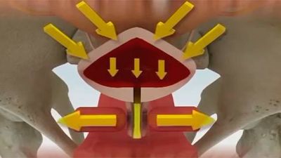 Cómo mitigar la incontinencia urinaria