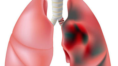 Más de dos millones de españoles sufren EPOC, pero el 70% lo desconoce