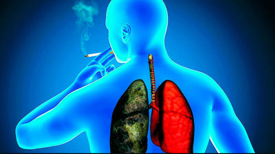 El cáncer de pulmón se cobra la vida de 17.000 españoles cada año